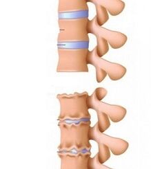 Stadien von Osteochondrose -Rampen aus dem Hals