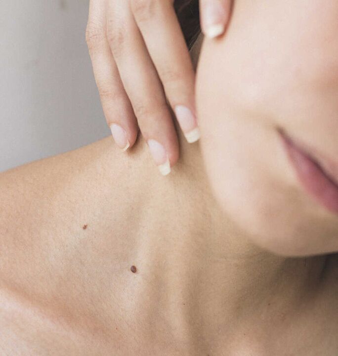 Steifheit im Nacken ist eines der Symptome im Anfangsstadium einer Osteochondrose der Halswirbelsäule.