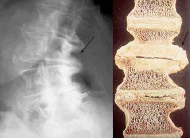 Schädigung der Wirbel bei thorakaler Osteochondrose.