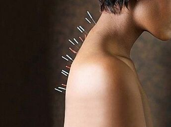 Die Reflextherapie ist eine wirksame Methode zur Behandlung der zervikalen Osteochondrose.