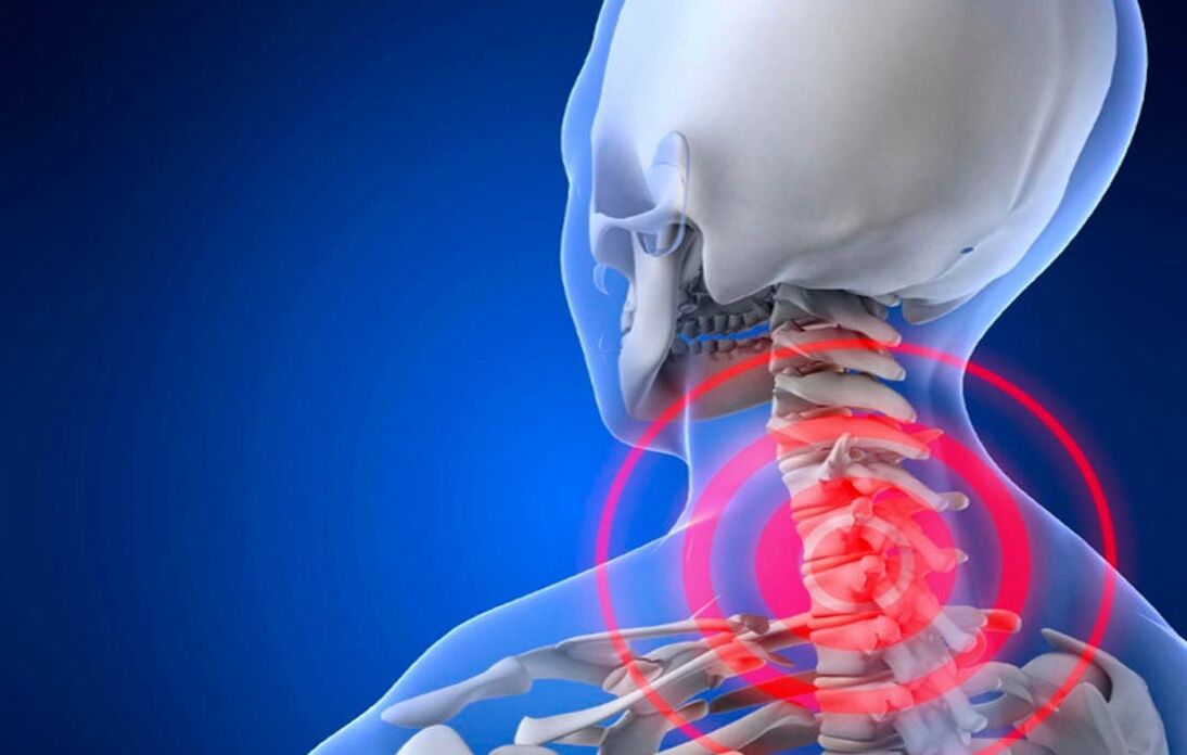 Osteochondrose der Halswirbelsäule
